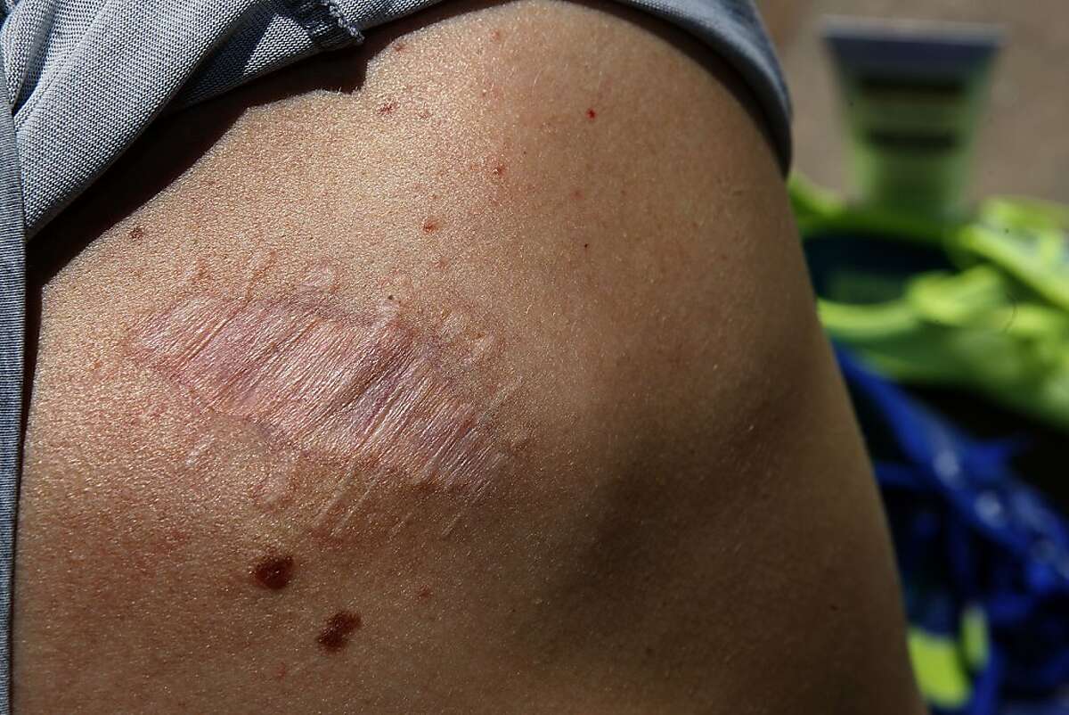 Stanford track member Erik Olson shows the skin cancer scar on his back at Cobb track at Stanford University in Palo Alto, Calif., on Friday, July 5, 2013. Erik was diagnosed with skin cancer at age 20. Stanford recently launched a program to encourage it's athletes to lather up with sunscreen and practice safe habits when it comes to sun exposure.