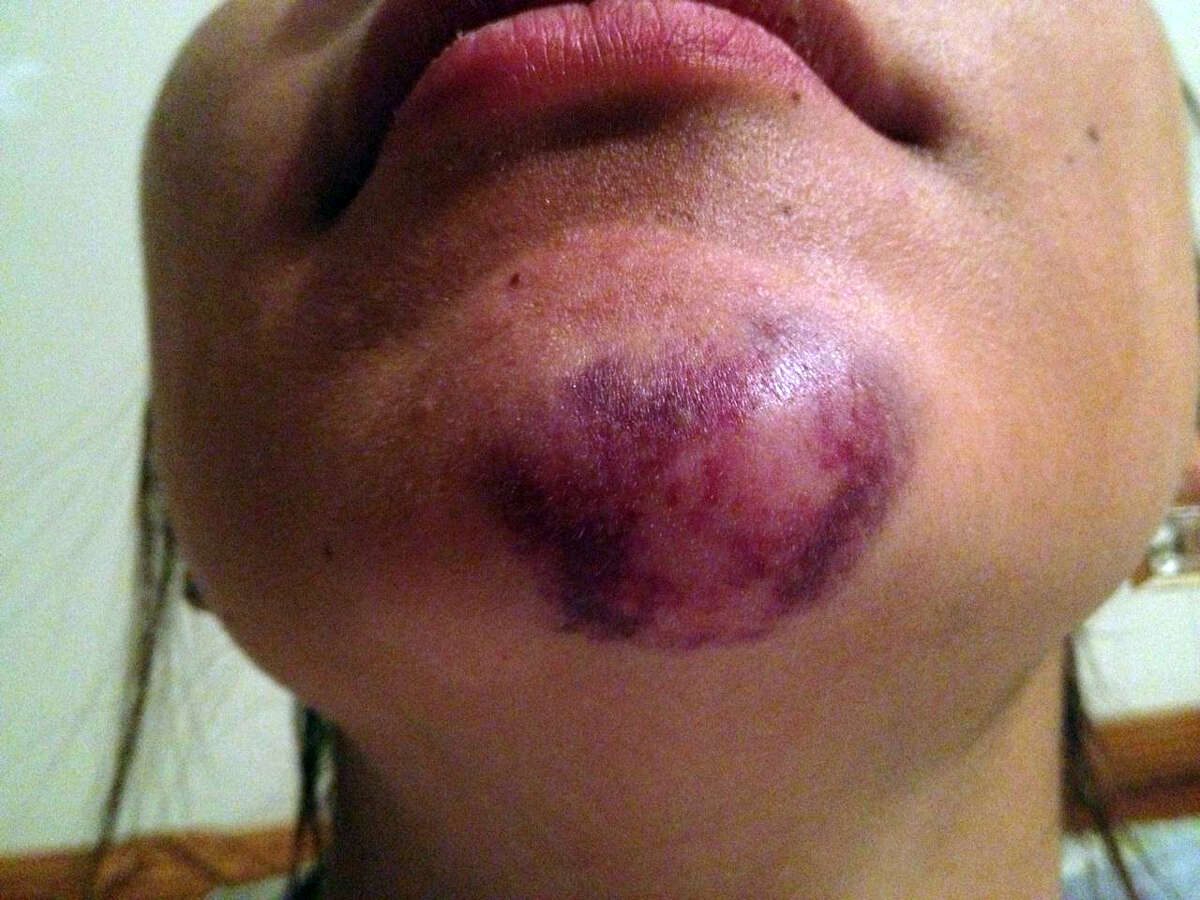 Texas State University student Alexis Alpha shows the injuries suffered to her chin. Alpa. who is a senior marketing student and is from The Woodlands, is alleging that a San Marcos Police officer struck her casing the injuries.