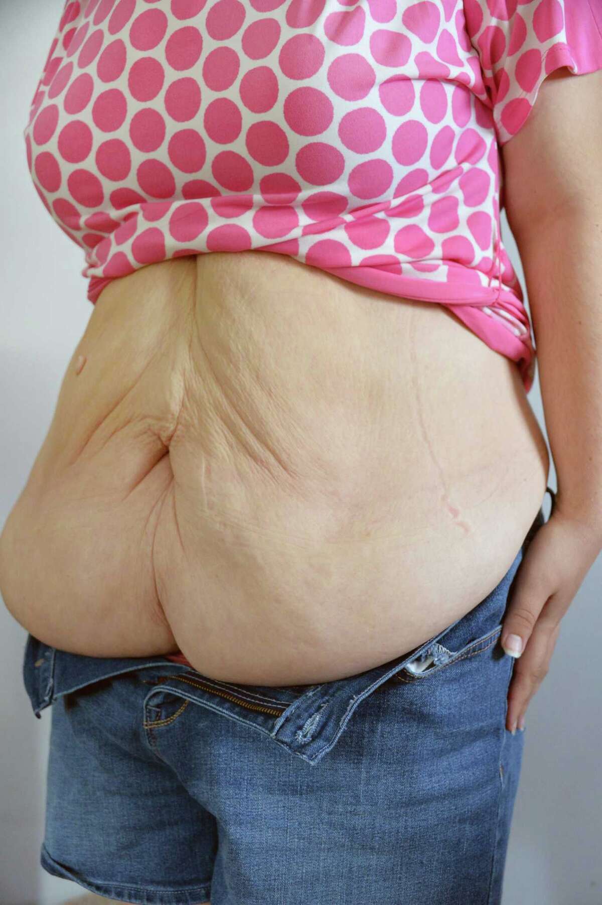 After weight loss, skin remains