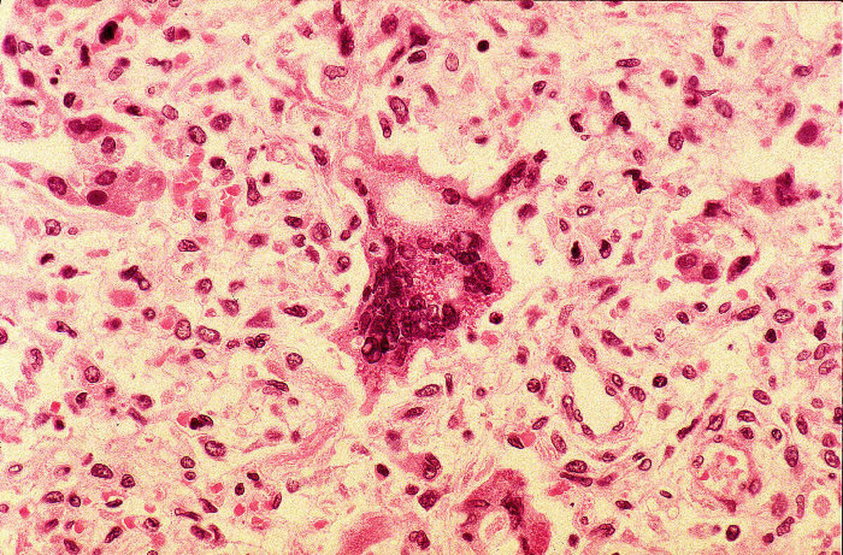 This file photo from the Centers for Disease Control and Prevention shows cells infected with the measles.