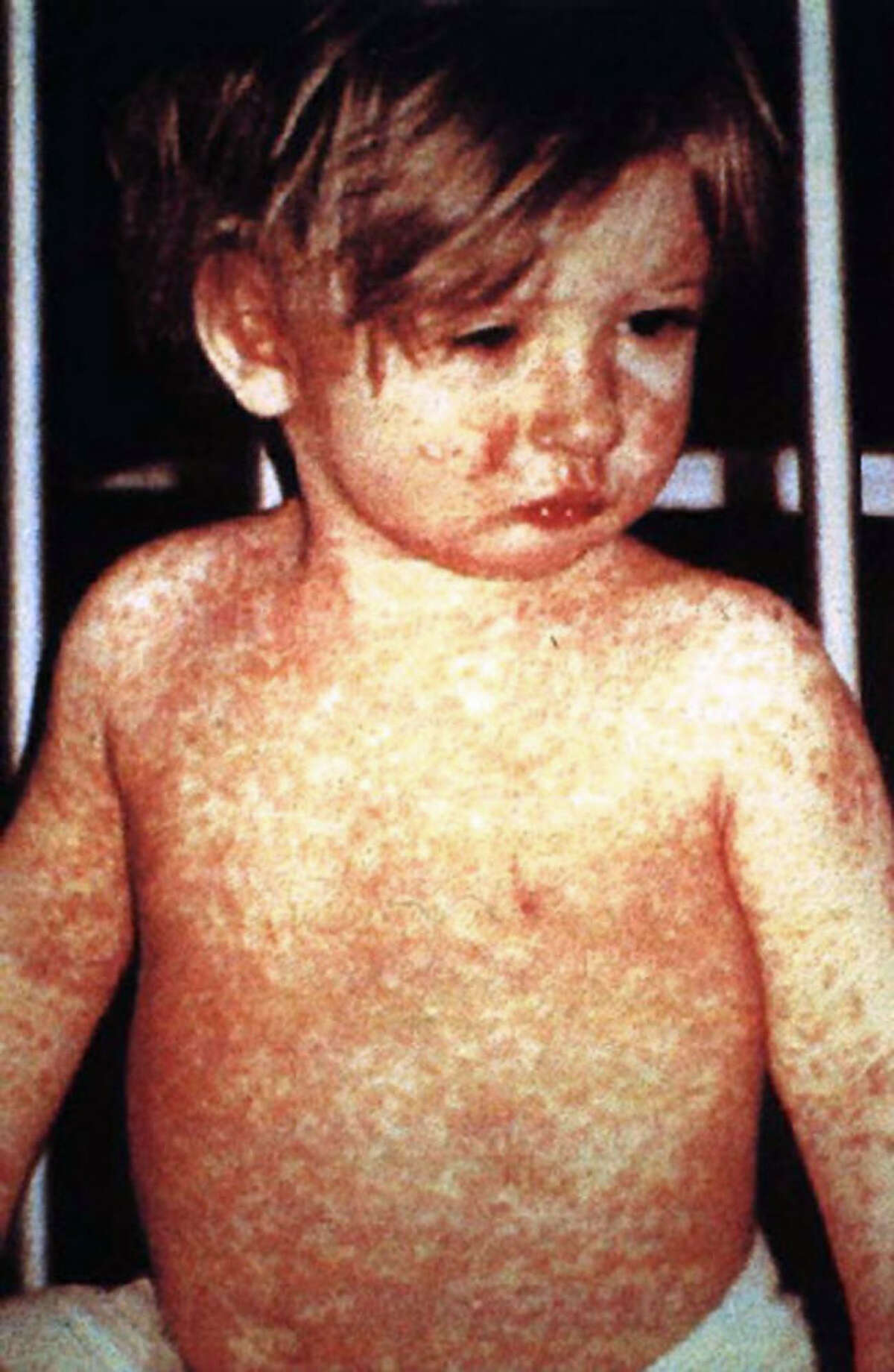 health-alert-issued-as-measles-suddenly-spreads-near-dallas