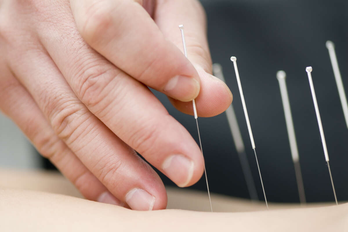 Acupuncture Is Becoming Mainstream Medical Treatment - HoustonChronicle.com