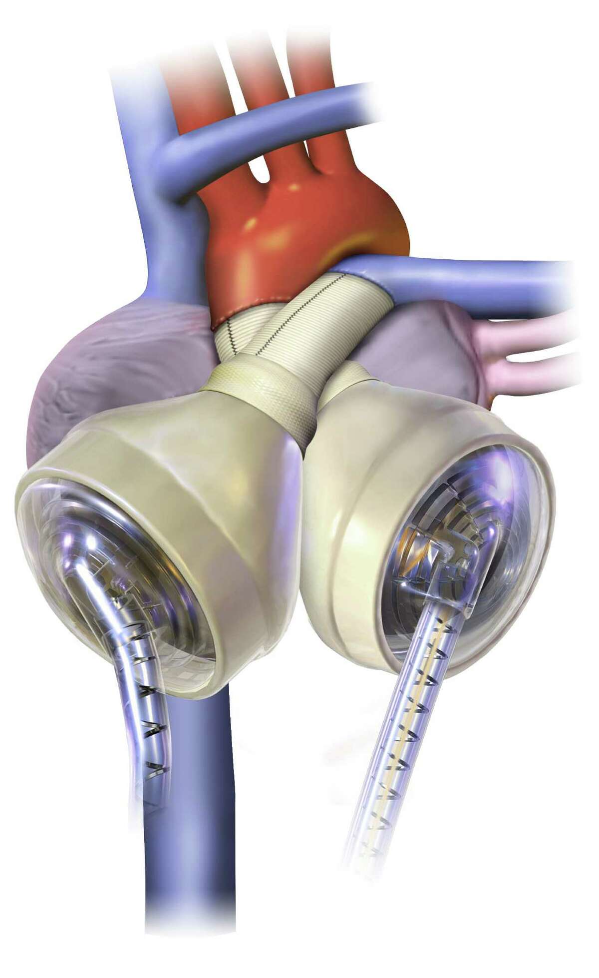A total artificial heart gives Beaumont man new hope