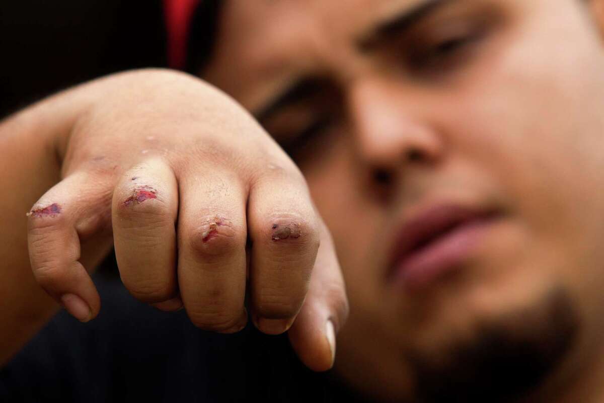 Osby Pinles shows his bloody knuckles after he tried to pull two female pit bulls off a woman around 2 a.m. on the corner of Glen Prairie and Leonora.