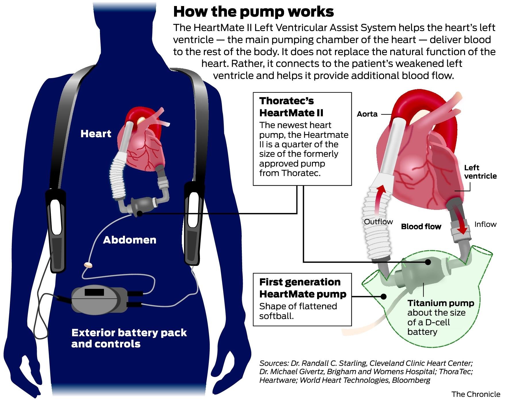 Thoratec warns of heart pump's link to 4 patient deaths - SFGate1786 x 1400