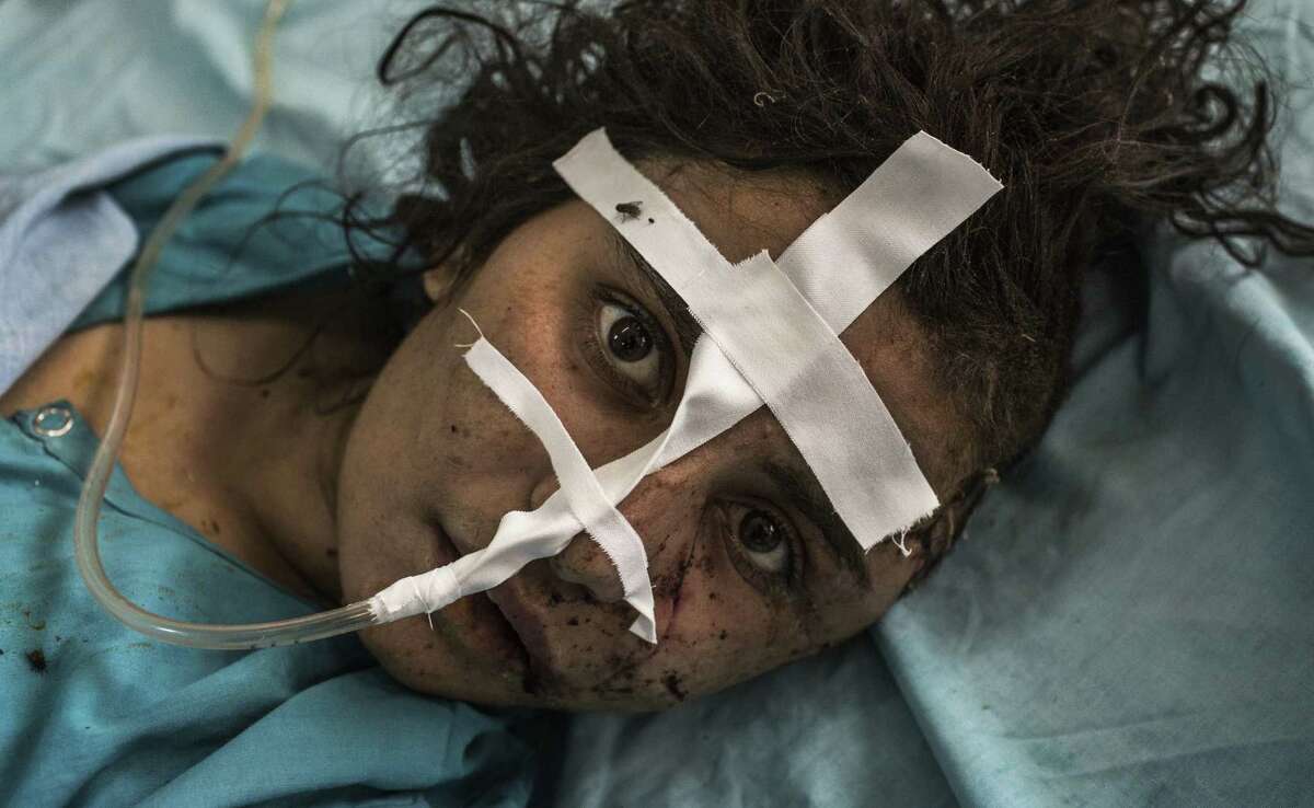 Gul Meena recovers from an ax attack at a hospital in Jalalabad, Afghanistan. Reportedly attacked by her brother for dishonoring their family, she was saved by villagers and doctors. “Honor killings” are not uncommon in Afghanistan.
