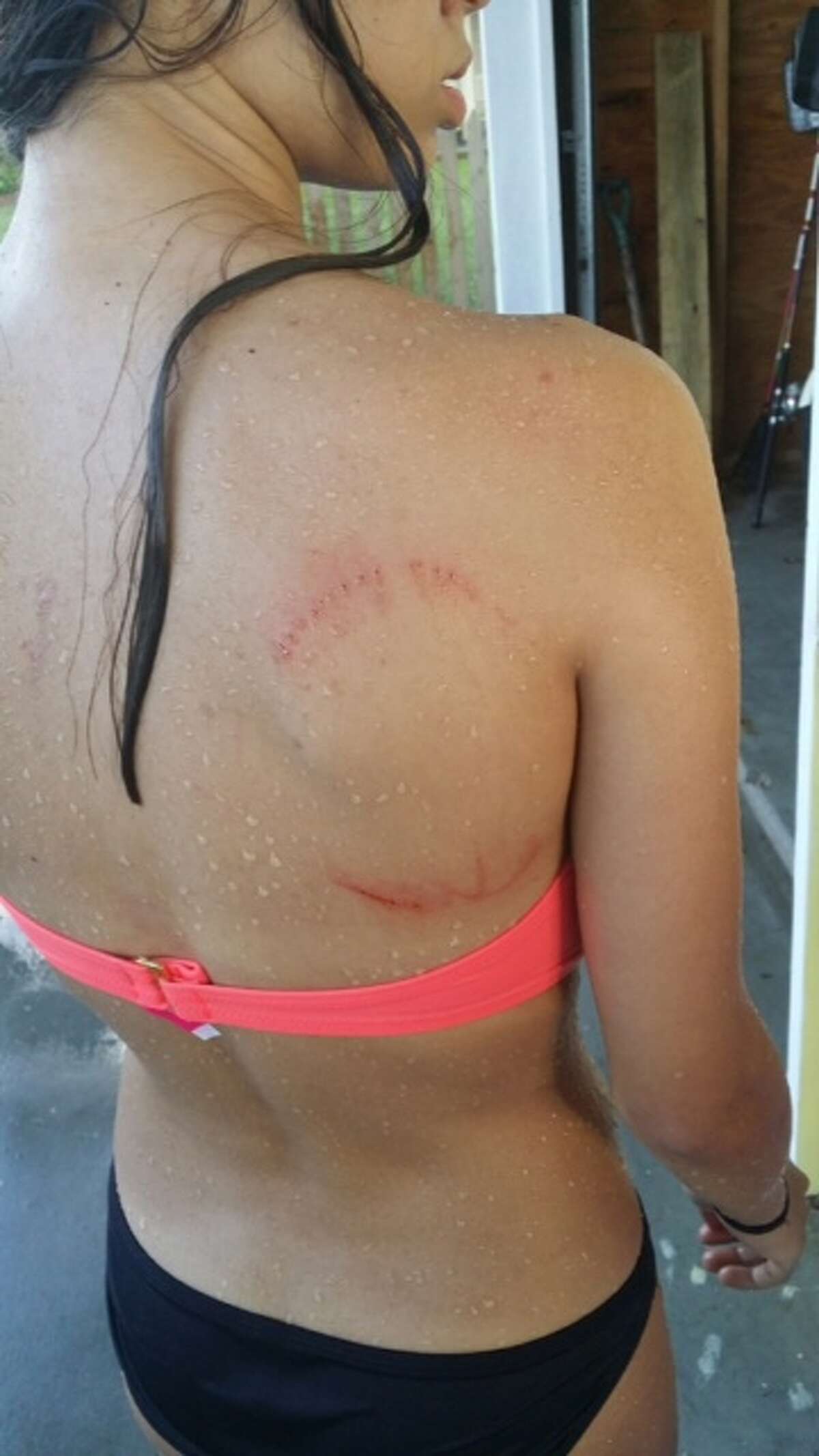 Bellaire teenager Mikaela Amezaga displays bite marks she believes were caused by a shark while she was swimming in Galveston.