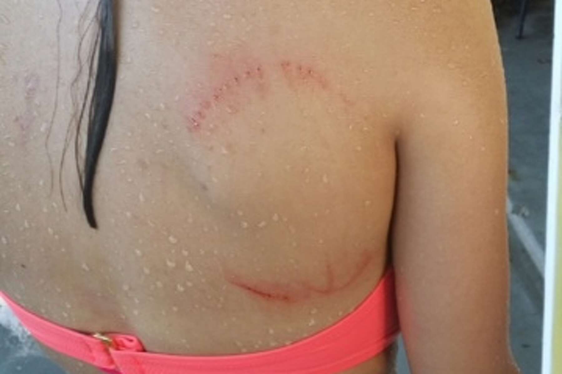 shark bite scar