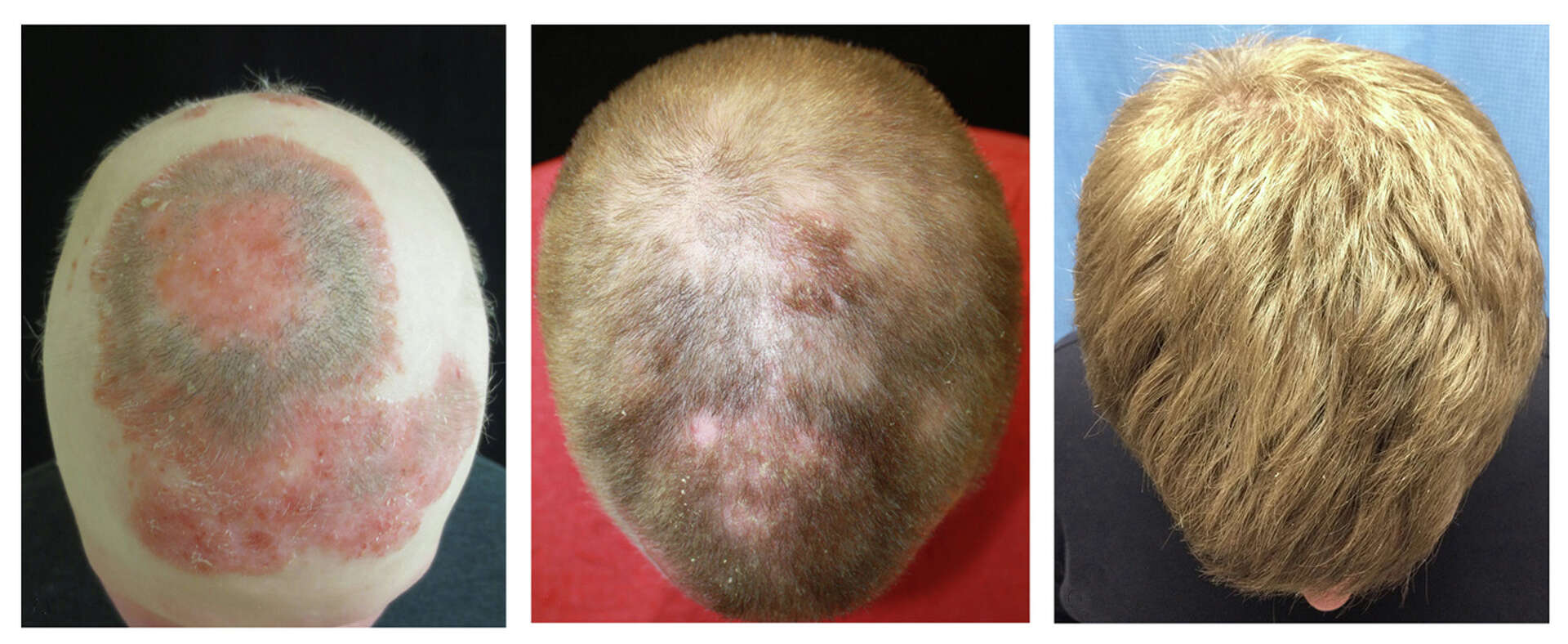 桑田佳祐 AND THE BALDING COMPANY Yale researcher on brink of baldness cure