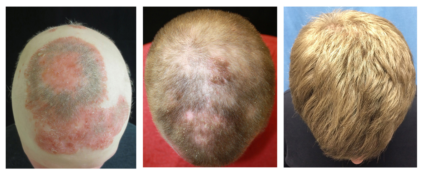 Hair Loss After Weight Loss Causes Risks and Prevention