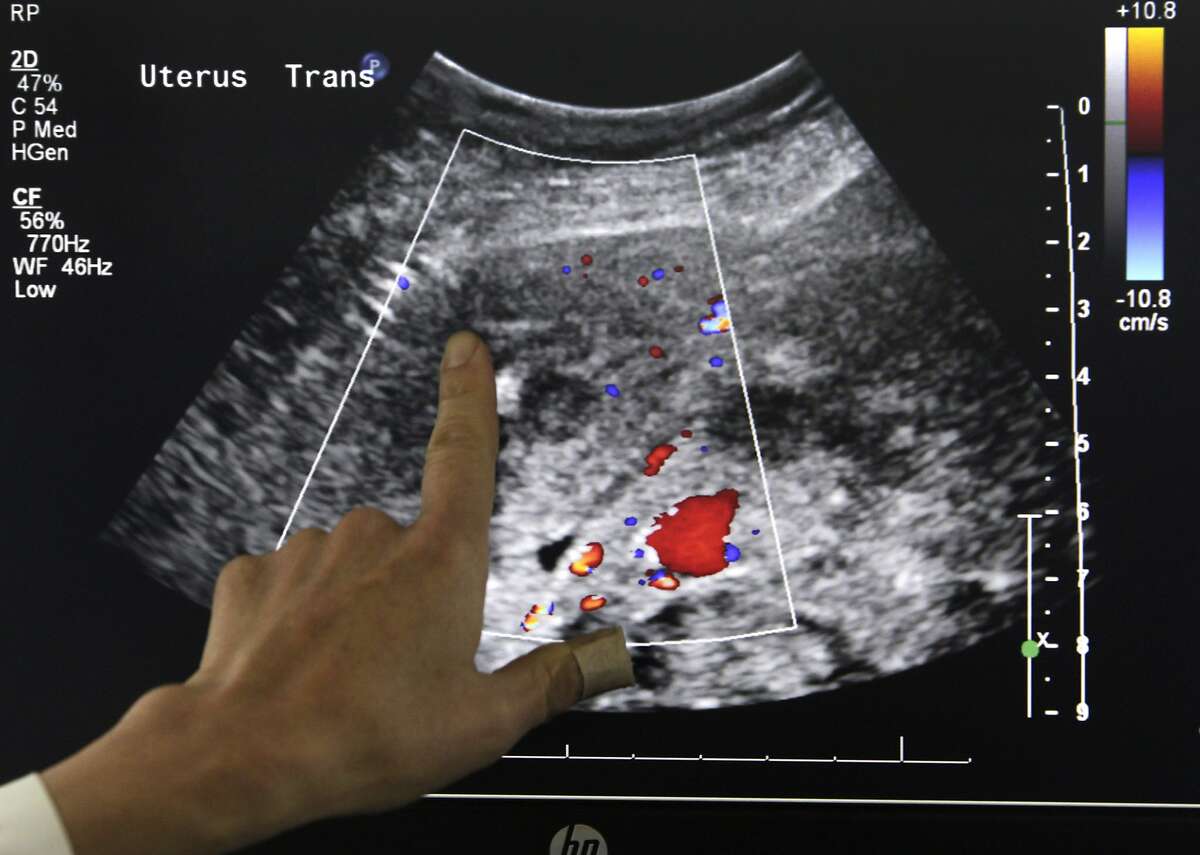 Норма яичников на узи. Pelvic Ultrasound.