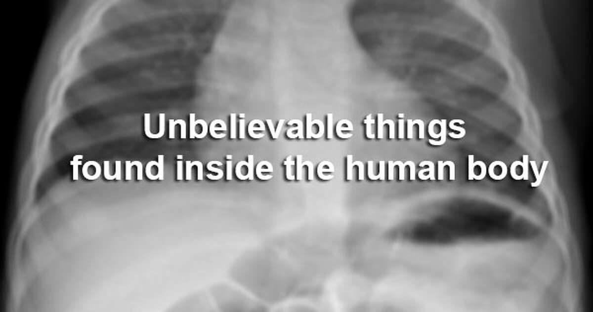 Strange Things Found In The Human Body