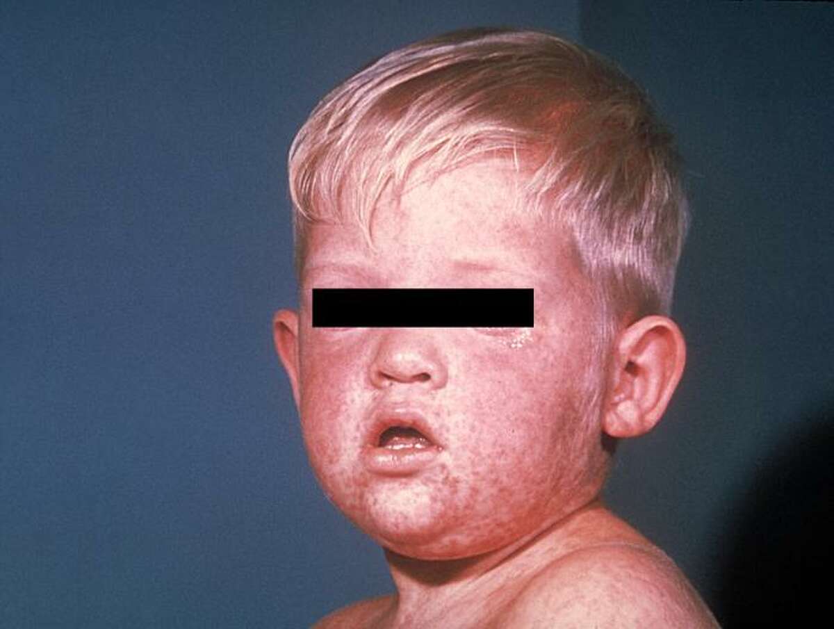Before the measles vaccination program in 1963, about 3 to 4 million people got measles each year in the United States. Of those people, 400 to 500 died, 48,000 were hospitalized, and 4,000 developed encephalitis (brain swelling) from measles.