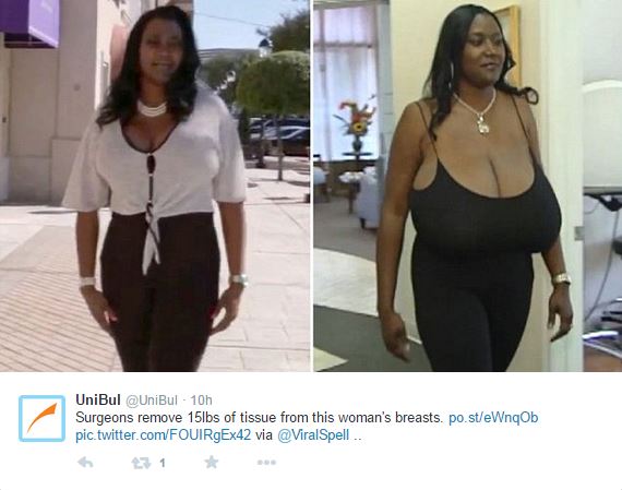 Hope for Nigeria Texas woman gets breast reduction from '36NNN' to