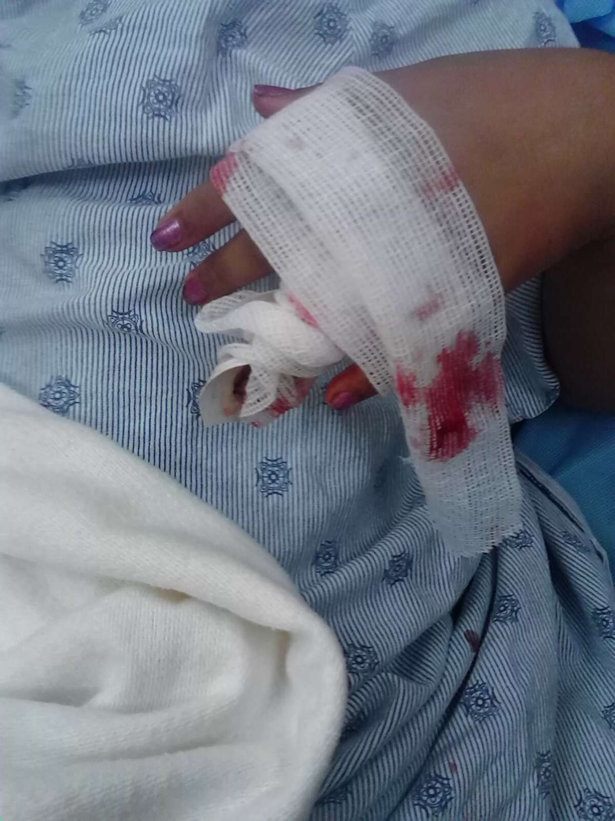 Desiree Zertuche had to have pins and stitches put into her hand after a dog bit her, breaking three bones in her ring finger.