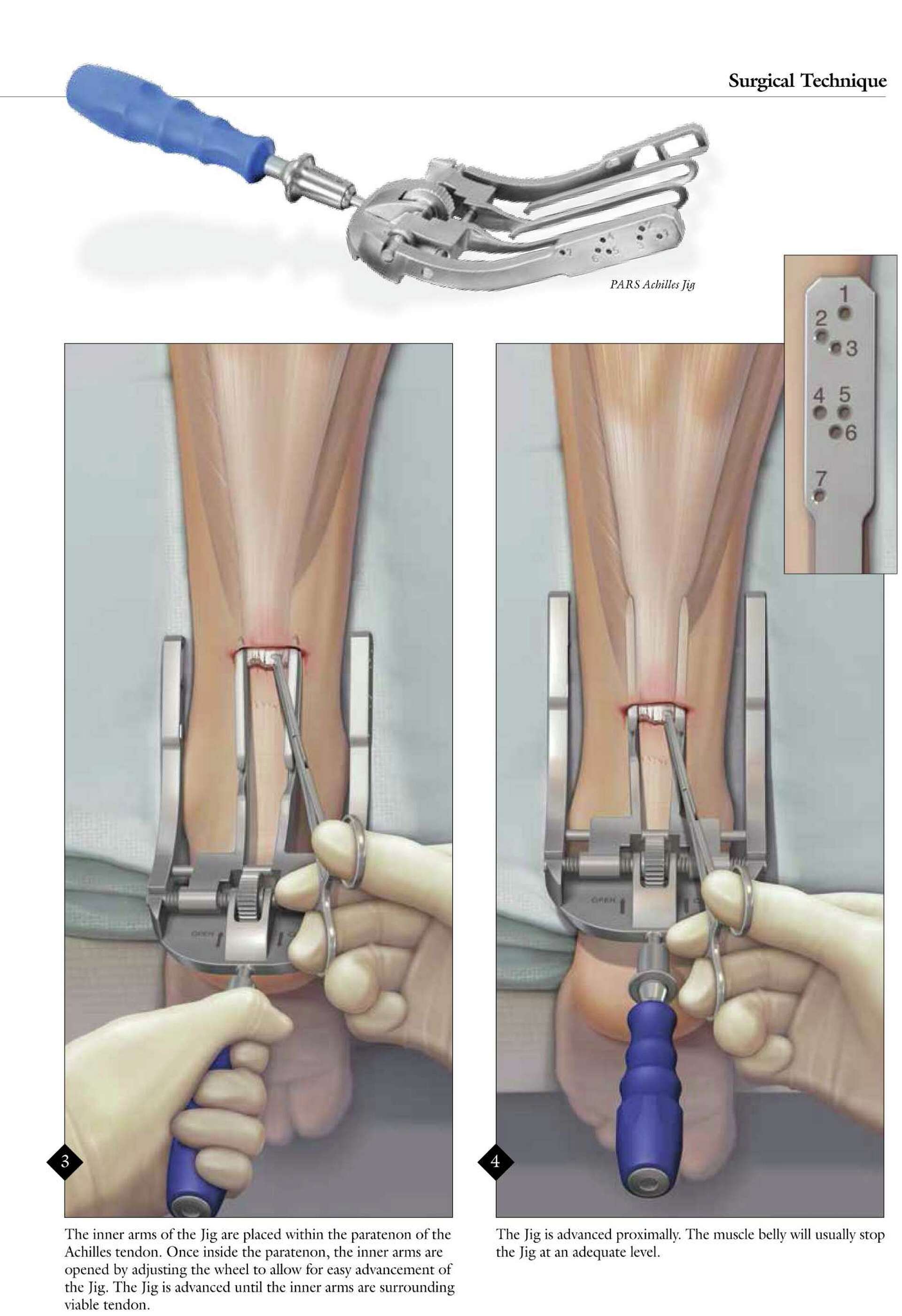 Pars Device NFL player gets his career back on track after surgery
