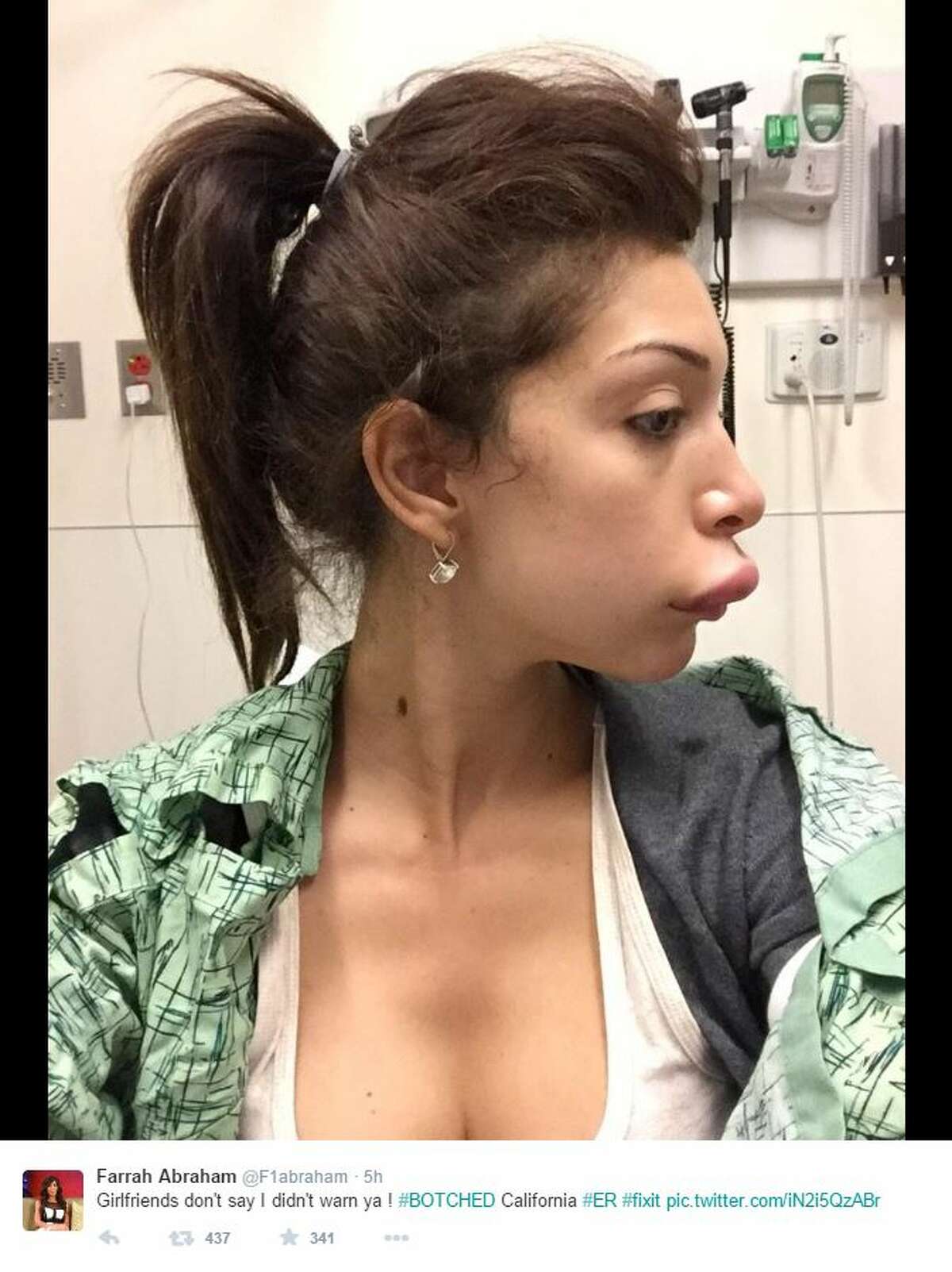 Farrah Abraham, a former star on MTV's "Teen Mom" and "16 and Pregnant" who became a porn actress, looks like she stuck her upper lip in a hornet's nest after some botched plastic surgery. In photos posted to her Twitter profile Tuesday, Abraham's lip looks extremely swollen after an injection gone wrong.