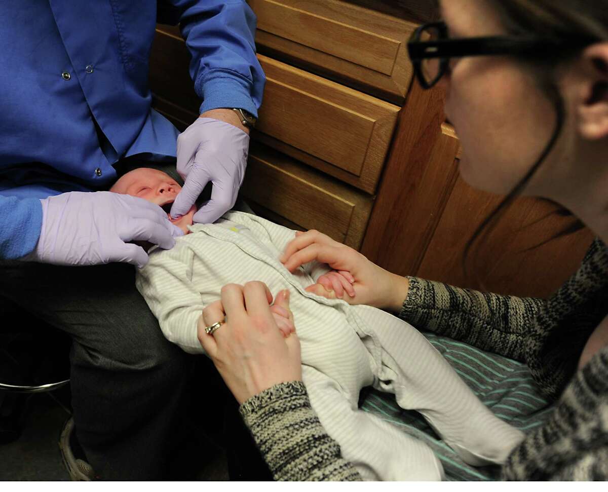 'Tiedtongue' impedes breastfeeding by some babies