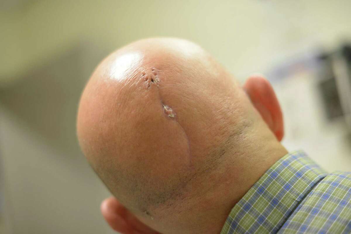 David Williams of Natalia is the first person in the world to have a radiation treatment implant put directly into his brain to fight a tumor. Here, he displays two scars on his scalp. The longer scar at the bottom is from surgery to remove the tumor and the top much smaller scar is where a catheter was used to place the implant. The technology emits tiny radioactive liposomes, or fat particles. The novel treatment is the work of physicians at the University of Texas Health Science Center at San Antonio and is now part of a clinical trial taking place at the university's Cancer Therapy and Research Center.