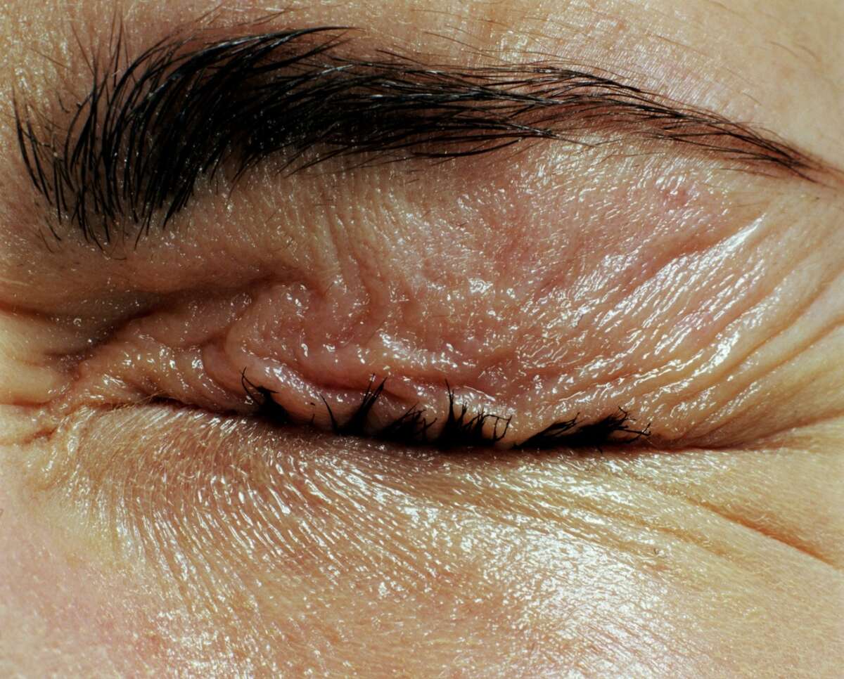 Parasitic worms likely entered eye of woman during Carmel Valley trail run