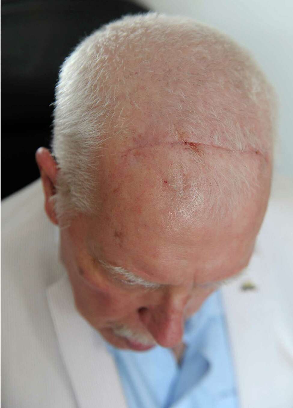 Deep brain stimulation surgery rejuvenates Parkinson's patient