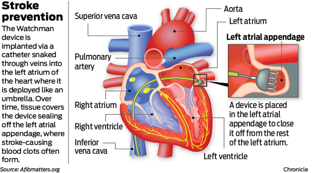 Stroke prevention The Watchman device is implanted via a catheter snaked through veins into the left atrium of the heart where it is deployed like an umbrella. Over time, tissue covers the device sealing off the left atrial appendage, where stroke-causing blood clots often form.