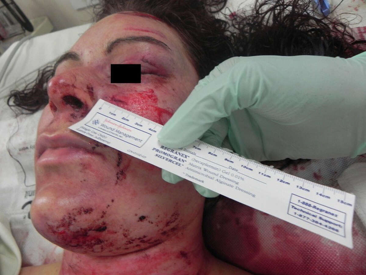 A Michigan woman brutalized and raped aboard a Holland America Line cruise is pictured shortly after the Feb. 14, 2014, attack is pictured in a photo provided by her attorney. The man who attacked her, Ketut Pujayasa, is currently serving 30 years in federal prison. She has since sued Holland America claiming the cruise line’s security procedures failed to protect her from Pujayasa, a room service attendant on the ship.