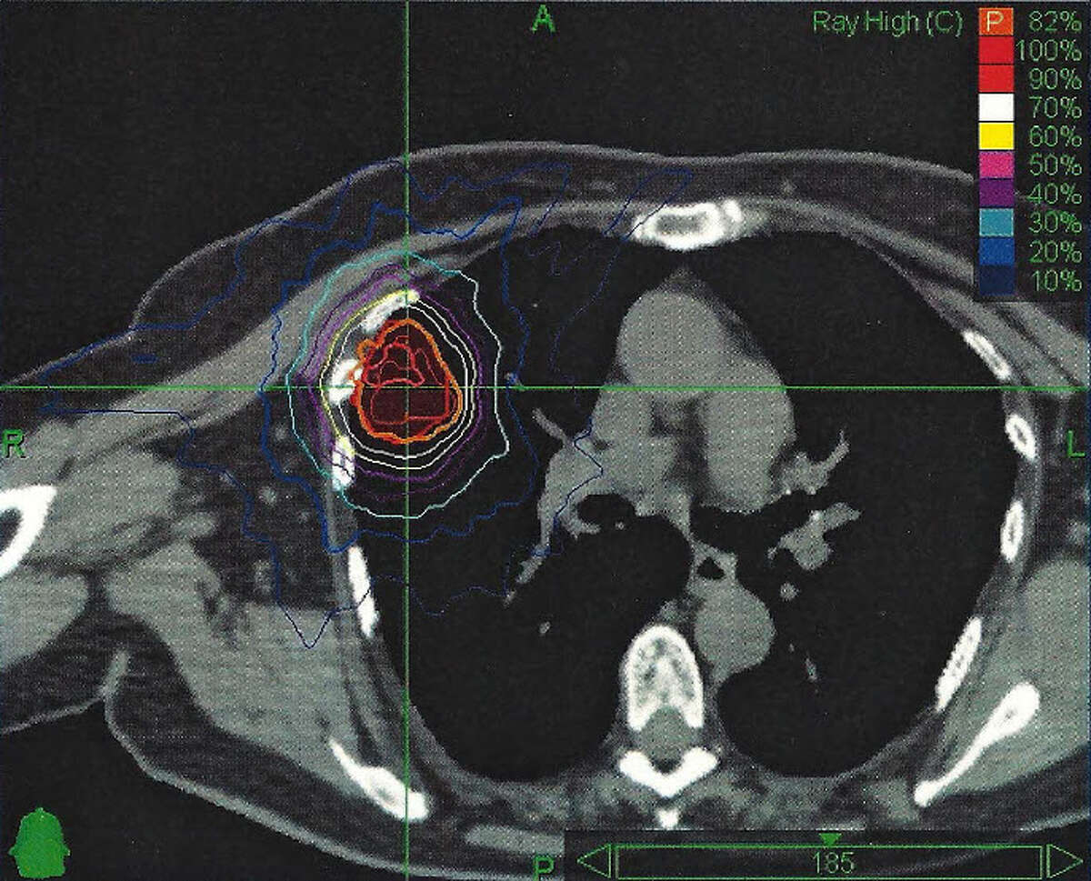 Focused radiation treatment targets lung cancer