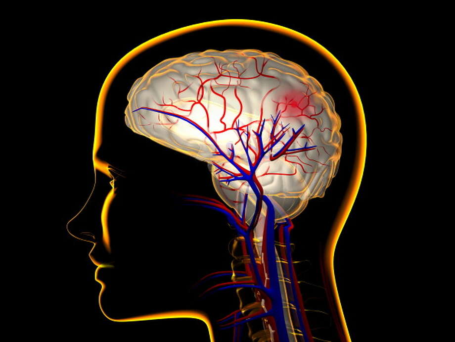 of conditions that affect the circulation of blood to the brain