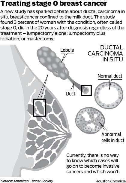 Point: Take less aggressive approach with Stage 0 breast cancer ...