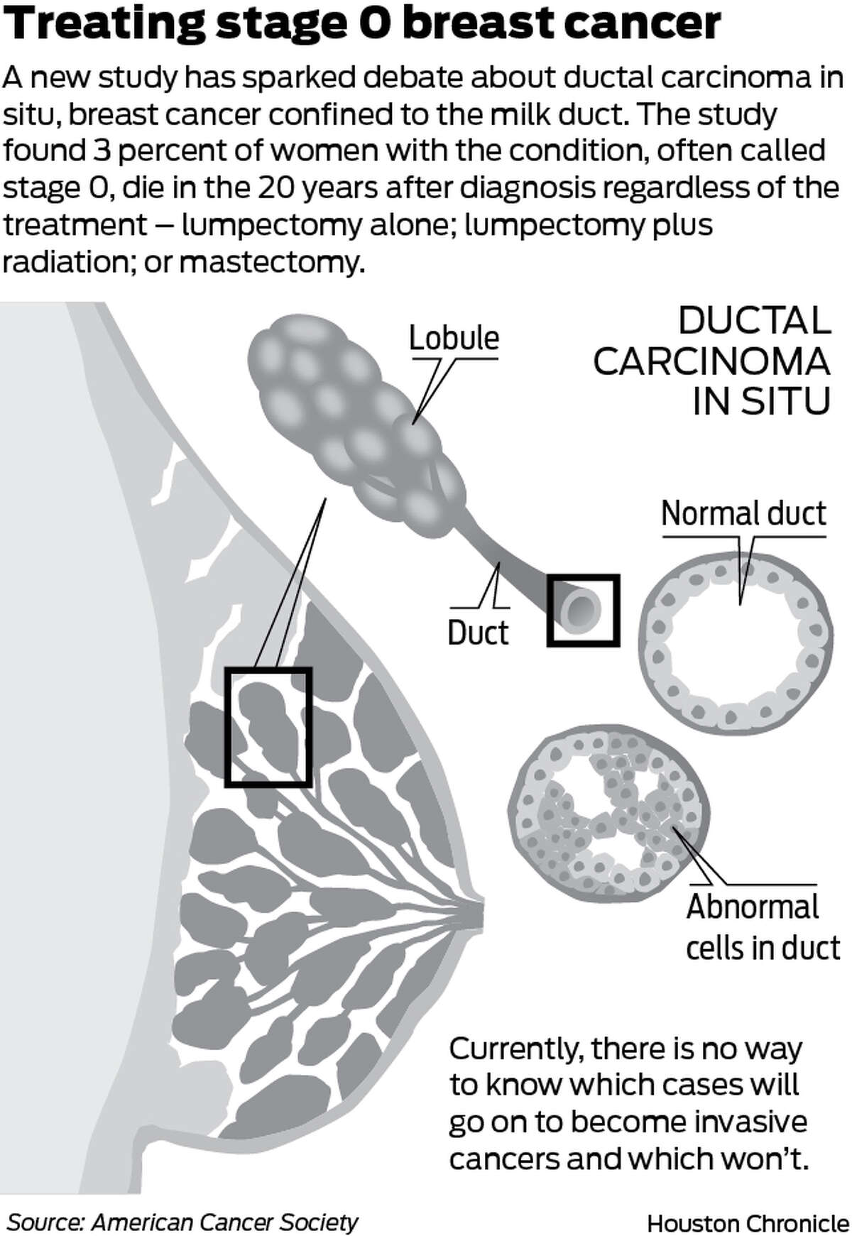 What Does Breast Cancer Stage 0 Mean