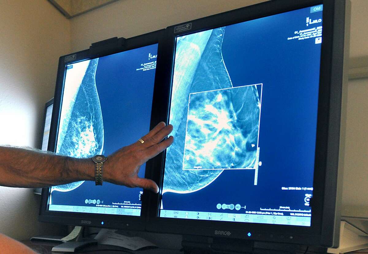 In this Tuesday, July 31, 2012, file photo, a radiologist compares an image from earlier, 2-D technology mammogram to the new 3-D Digital Breast Tomosynthesis mammography in Wichita Falls, Texas. The technology can detect much smaller cancers earlier. In guidelines published Tuesday, Oct. 20, 2015, the American Cancer Society revised its advice on who should get mammograms and when, recommending annual screenings for women at age 45 instead of 40 and switching to every other year at age 55. The advice is for women at average risk for breast cancer. Doctors generally recommend more intensive screening for higher-risk women. (Torin Halsey/Times Record News via AP)