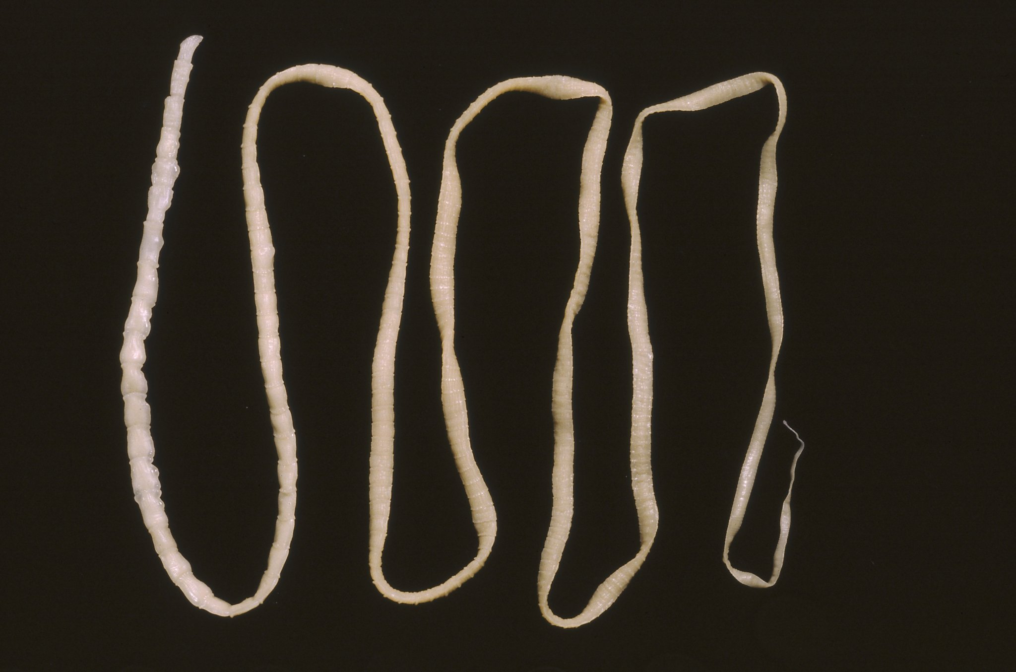 Man gets fatal cancer from his own tapeworm