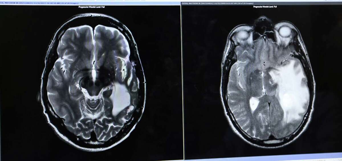 Two MRI's showing the tumor, left, discovered in Matt Futer and then later, after the tumor was removed, the fluid that filled into the space. Photos of an appointment with Houston Methodist Hospital neurosurgeon David Baskin and his former brain cancer patient Matt Futer and Futer's father, Christopher on Friday, Oct. 9, 2015, in Houston. Futer was successfully treated with viral immunotherapy 10 years ago. ( Elizabeth Conley / Houston Chronicle )