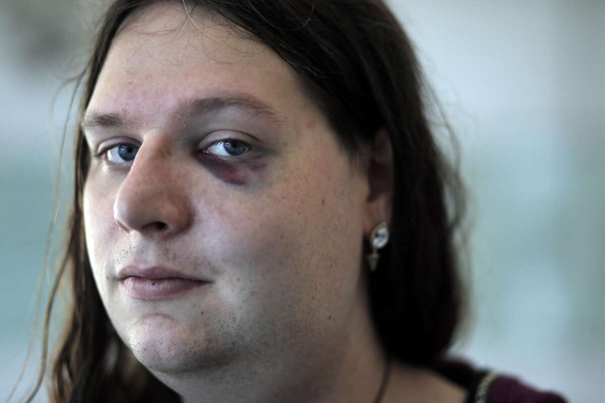 Samantha Hulsey, a transgender woman was attacked by what police are calling a hate crime in San Francisco, Calif., on Monday, November 16, 2015. Samantha emerged with a black eye, some upper body pain and swelling to her face and neck from the incident.