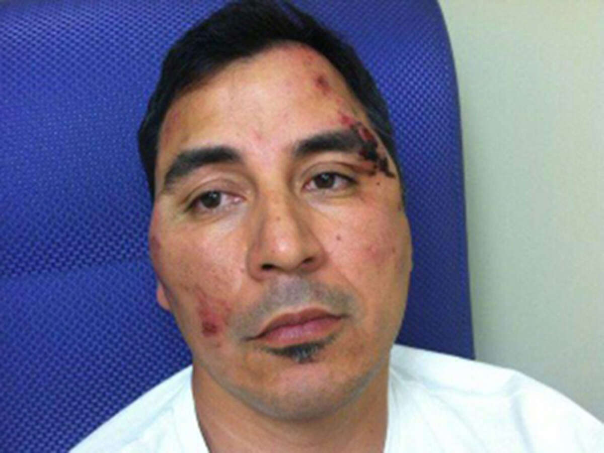 Roger Carlos is getting physical therapy in Houston for paralysis resulting from complications of surgery to relieve pain he suffered during the mistaken beating by San Antpnio Police Department officers. He is shown here after he was beaten.