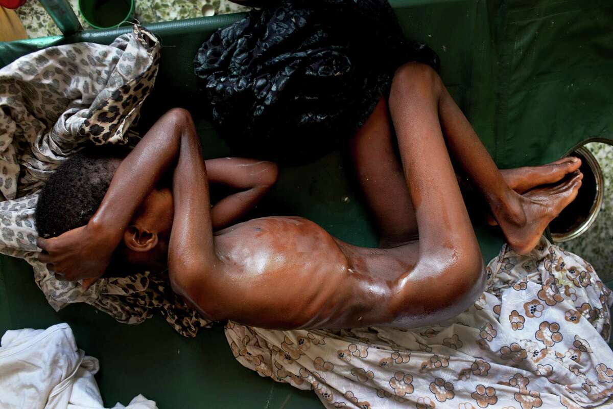 A malnourished child in a hospital in Mogadishu, Somalia, July 27, 2011. The al-Qaida-linked militant group al-Shabab, which controls much of southern Somalia, is blocking starving people from fleeing the country and setting up a cantonment camp where it is imprisoning displaced people who were trying to escape Shabab territory. (Tyler Hicks/The New York Times)
