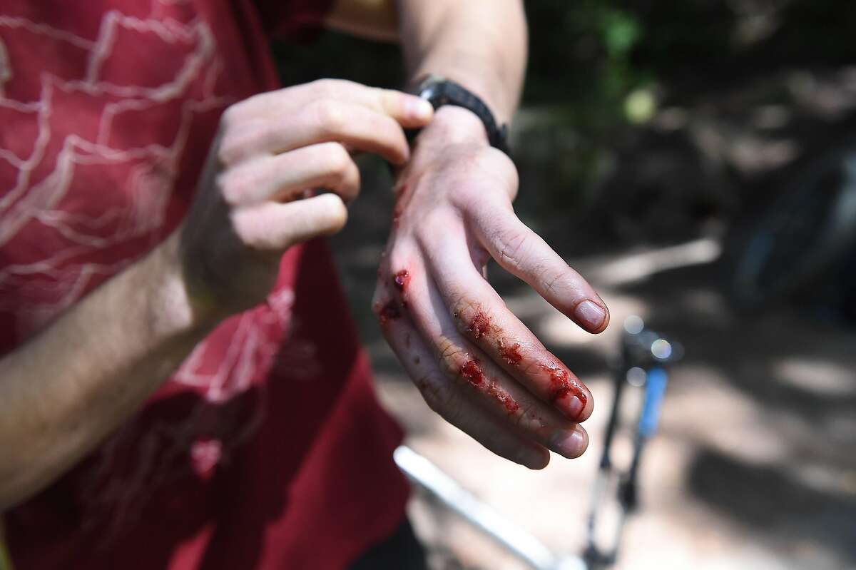 Glenn Fiedler fell off his bike and got scraped up in Marin on Friday, April 1, 2016. Marin County park rangers are starting a new program to use radar guns to monitor, and later to enforce, the 15 mph speed limit for mountain bikers on Marin County open space land.