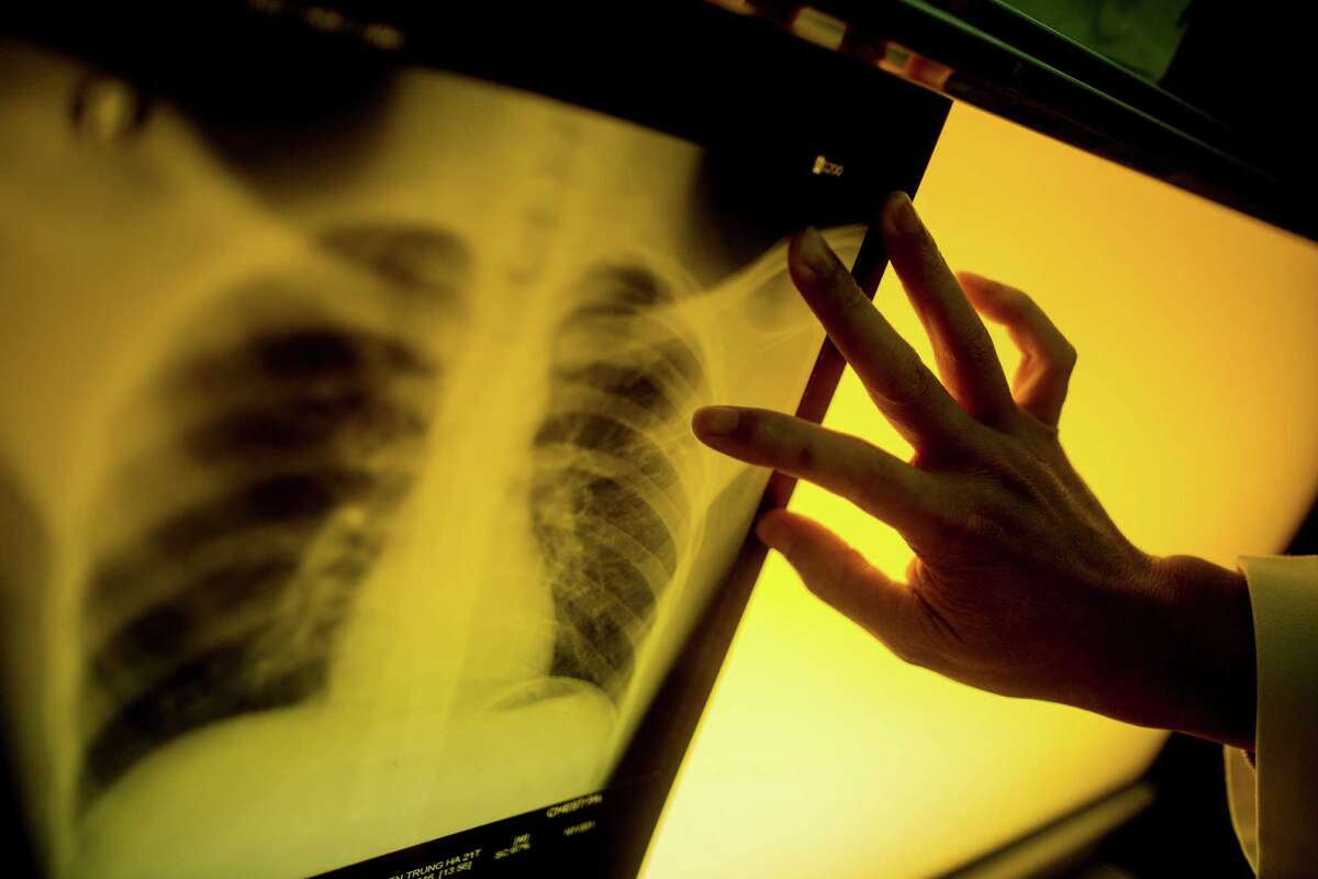 A technician points to a spot on a patient's X-ray that shows signs of tuberculosis infection, in Hanoi, Vietnam. The countryÂ?’s stunning progress against deadly tuberculosis is being threatened by reduced funding for a health care system stretched thin. (Justin Mott/The New York Times)