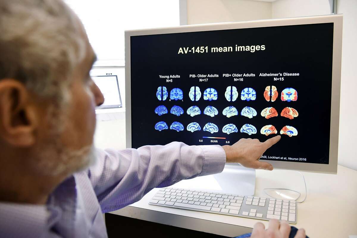 Professor of Public Health and Neurosciences, William Jagust MD talks about his research into aging and dementia using PET scanning while looking at brain images in his office in the Jagust Lab at the Berkeley National Laboratory in Berkeley, CA Friday, April 1, 2015.