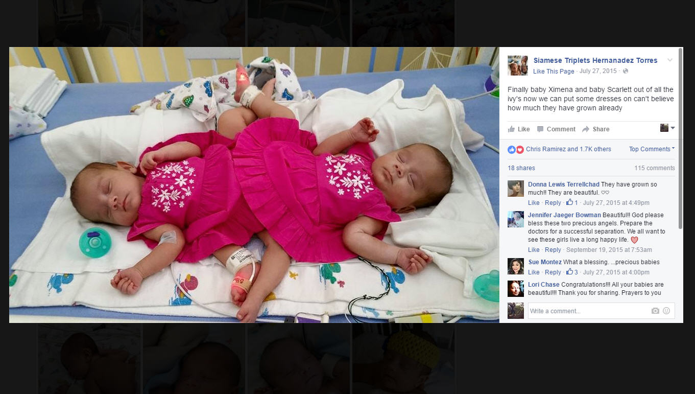 Formerly Conjoined Twins Triplet Sister To Celebrate 1st Birthday At