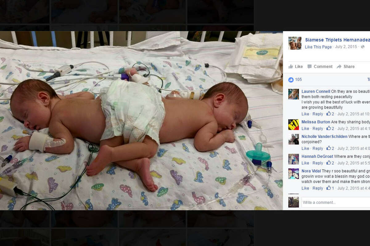 Formerly Conjoined Twins Triplet Sister To Celebrate 1st Birthday At Hospital In Texas 8084