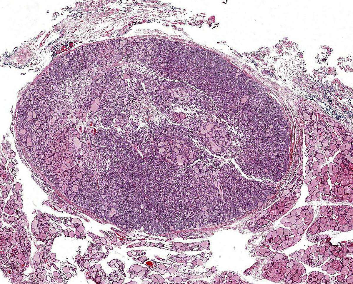 In an undated handout photo, a noninvasive follicular thyroid neoplasm with papillary-like nuclear features, or Niftp, a type of tumor that was previously considered a kind of cancer, but has been downgraded by a panel of doctors. As a result of the change, thousands of patients will be spared removal of their thyroid, treatment with radioactive iodine and regular checkups for the rest of their lives, all to protect against a tumor that was never a threat. (Dr. Yuri Nikiforov via The New York Times) -- NO SALES; FOR EDITORIAL USE ONLY WITH RECLASSIFIED TUMORS BY GINA KOLATA FOR APRIL 15, 2016. ALL OTHER USE PROHIBITED.
