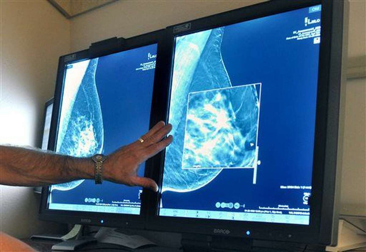 FILE - In this Tuesday, July 31, 2012, file photo, a radiologist compares an image from earlier, 2-D technology mammogram to the new 3-D Digital Breast Tomosynthesis mammography in Wichita Falls, Texas. The technology can detect much smaller cancers earlier. In guidelines published Tuesday, Oct. 20, 2015, the American Cancer Society revised its advice on who should get mammograms and when, recommending annual screenings for women at age 45 instead of 40 and switching to every other year at age 55. The advice is for women at average risk for breast cancer. Doctors generally recommend more intensive screening for higher-risk women. (Torin Halsey/Times Record News via AP)