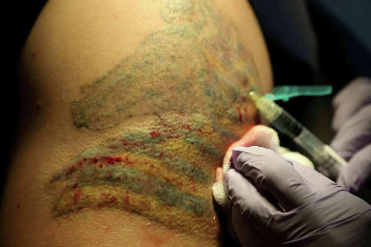 Tattoo Removal  Online with Handson Practicum