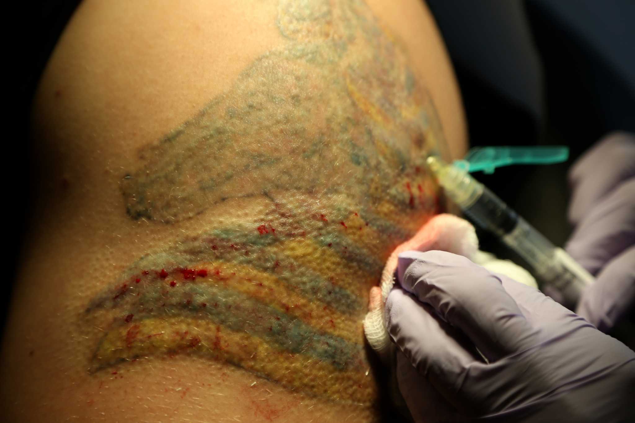 Zap that regret Better laser speeds tattoo removal