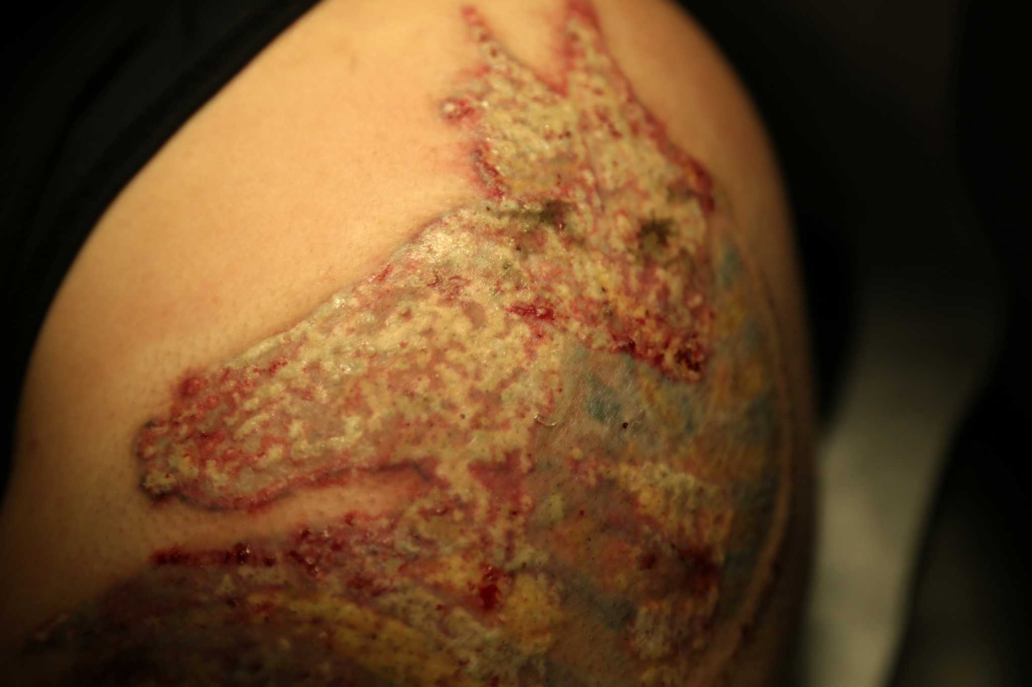 Zap that regret Better laser speeds tattoo removal