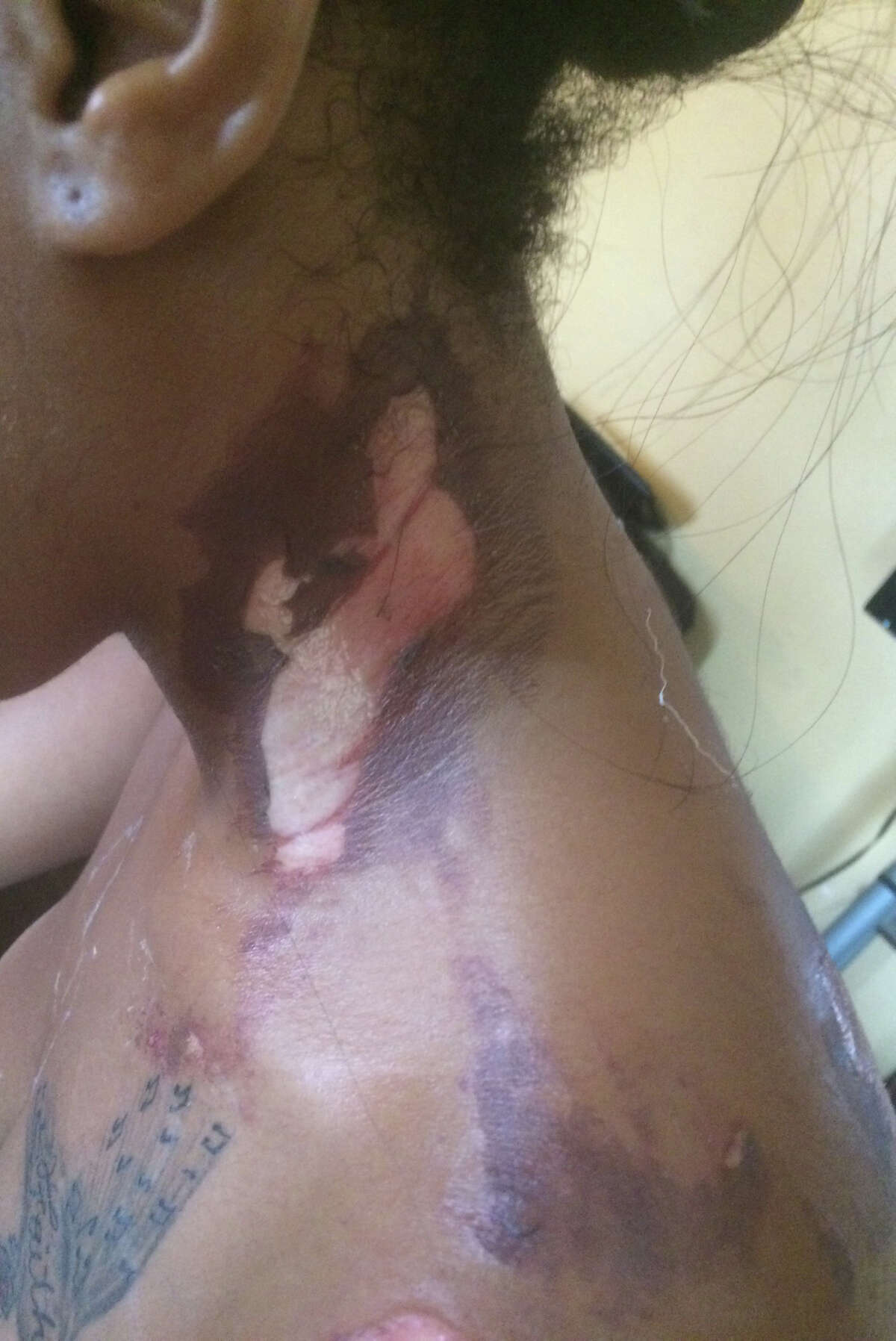 Haronisha Alexander, 19, alleges that she and her boyfriend, Johnson Moore, were burned with hot oil by Taco Bell employees at the restaurant located in the 3100 block of the South Loop.