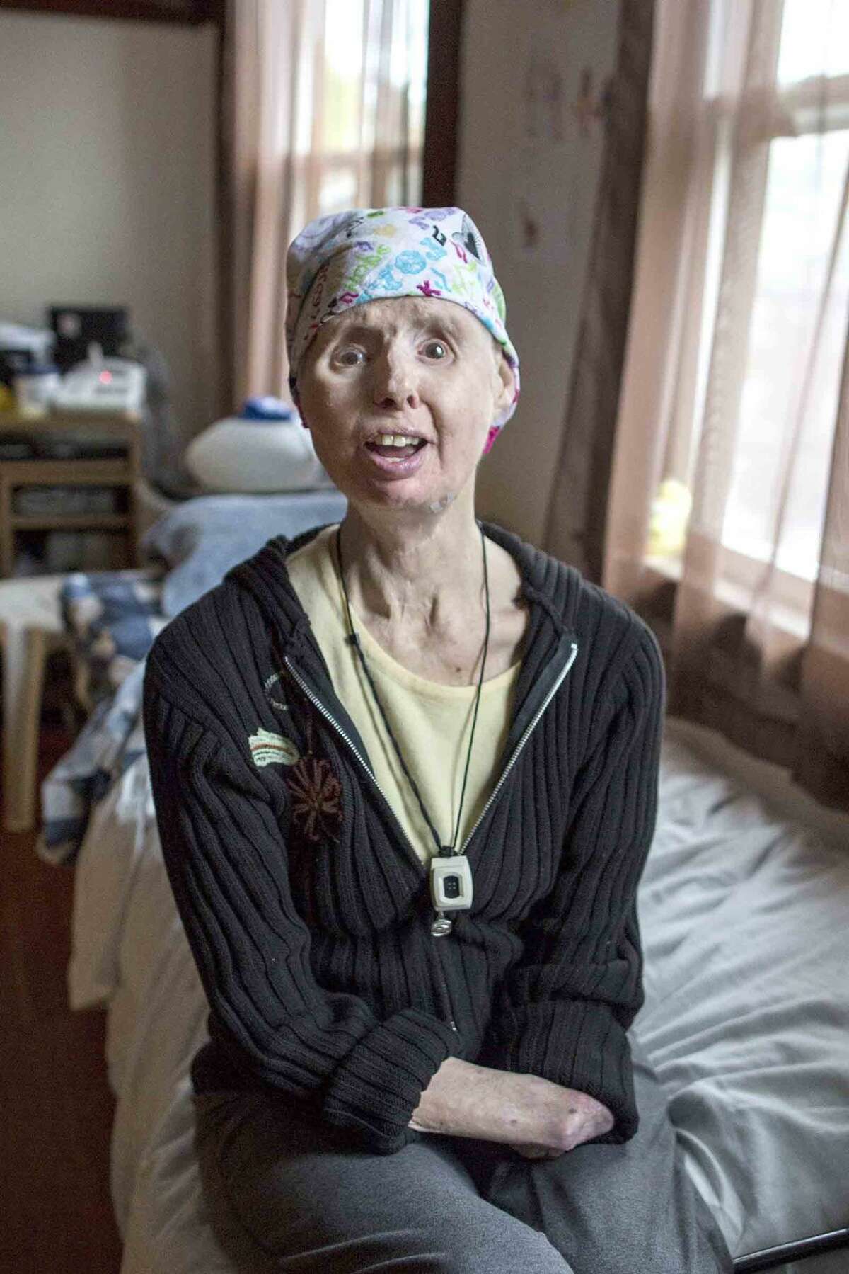 Charla Nash in her home in Boston, Massachusetts on Sunday, May 8, 2016. Nash received a full-face transplant in 2011 after being attacked by a chimpanzee. (Scott Eisen for The Stamford Advocate)
