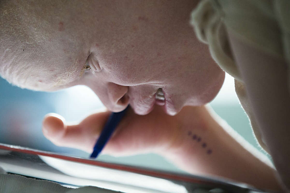 Emmanuel Rutema, 13, of Tanzania, with the hereditary condition of albinism, draws a picture on a clipboard before of his surgery at Shriners Hospital for Children in Philadelphia on Tuesday, June 30, 2015. The lack of pigments in parts of the eyes causes vision difficulties. (AP Photo/Matt Rourke)